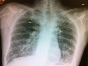 Figura 1: Radiografía simple de tórax donde se aprecian bronquiectasias en ambos lóbulos pulmonares. 