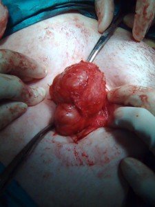Figura 2: Tumor desmoide adherido a la aponeurosis del músculo recto anterior del abdomen, tras la apertura de la piel a nivel de la cicatriz de la cesárea previa.