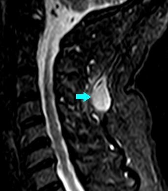 Sagittal MRI view, arrow show the nodule of about 1.5 cm-s hypointense on T1 sequence.