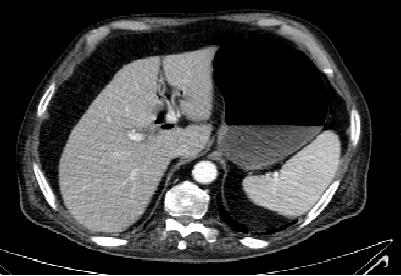 Fig. 2.TAC abdominal civ (aerobilia y fístula colecistoduodenal)