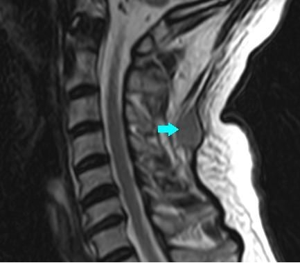 Fig. 2. Sagittal MRI view, arrow show a nodule of about 1.5 cm-s hyperintense on STIR sequence.