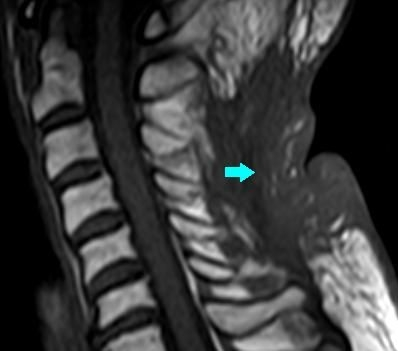 Fig. 4. Sagittal MRI view, arrow show the postoperative changes in T1 sequence.