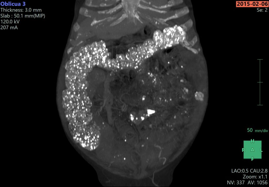 Ingesta de quelante de calcio en radiografía abdominal: diagnóstico diferencial: a propósito de un caso.