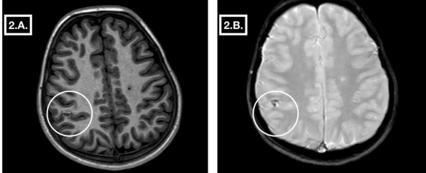 Endocarditis infecciosa subaguda: A propósito de un casopediátrico.