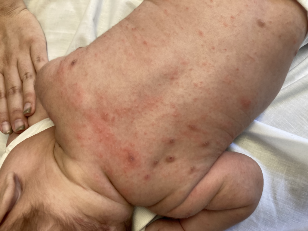 Neonato y Lactante con exantema pápulo-pustuloso e irritabilidad.