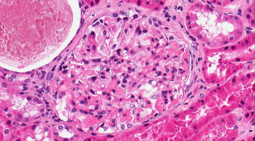 Hablemos del Síndrome Neurorrenal: nuevas dianas en laNefropatía Membranosa Primaria.     A propósito de un caso.